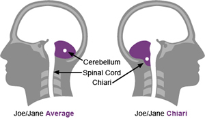 chiari_image.jpg