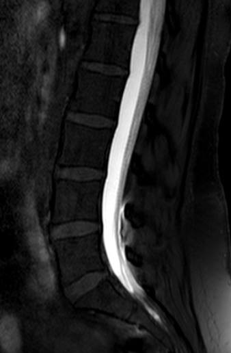 mri_myelography_with_intrathecal_contrast_cropped.jpg